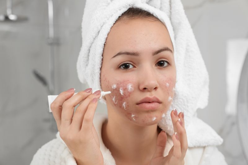Sử dụng kem trị mụn trứng cá tuổi dậy thì