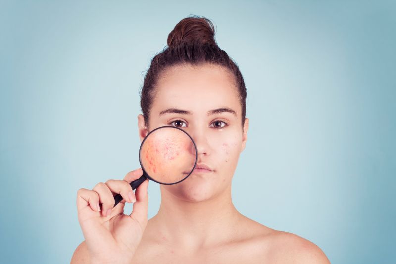 Mụn trứng cá trong độ tuổi dậy thì