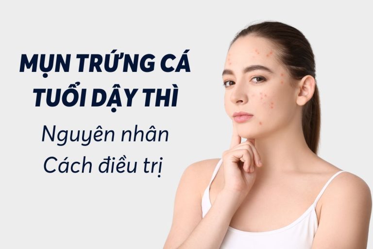 Mụn trứng cá tuổi dậy thì