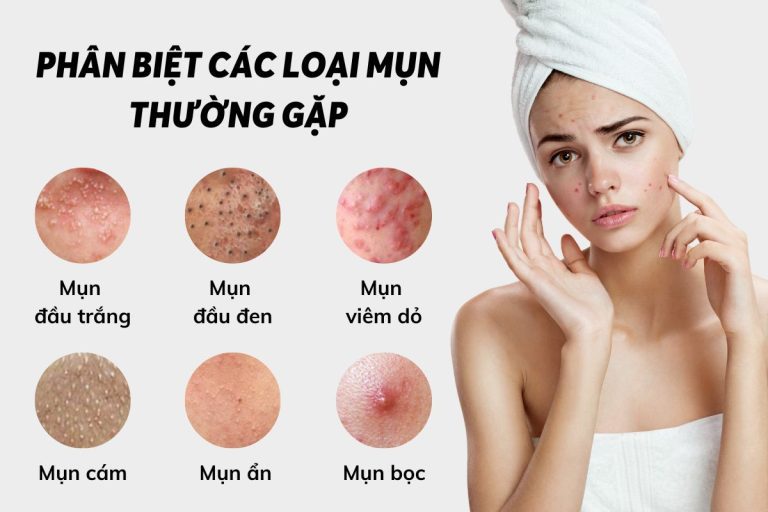 Phận loại các loại mụn thường gặp