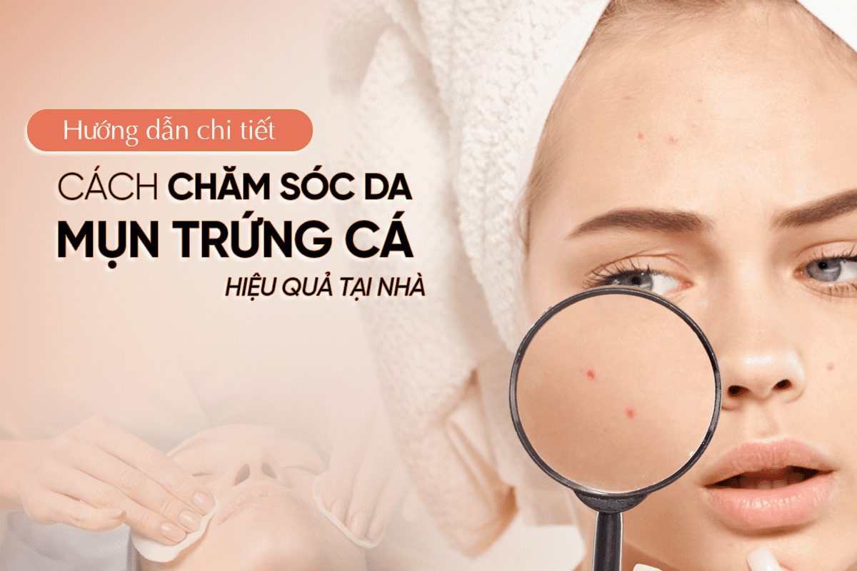 Hướng dẫn chăm sóc da mụn trứng cá