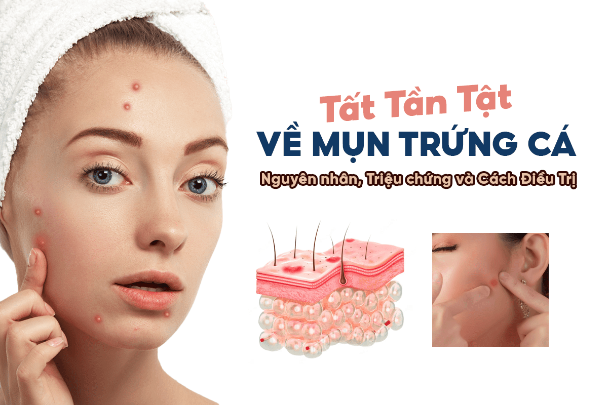 Nguyên nhân, triệu chứng và cách điều trị mụn trứng cá