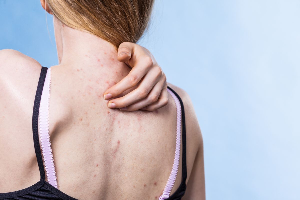 Ảnh hưởng của mụn trứng cá trên lưng đến cuộc sống thường nhật