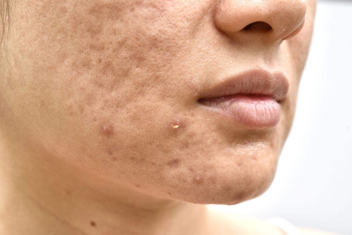 Biến chứng để lại của mụn trứng cá