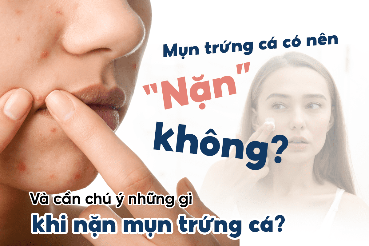 Nặn mụn trứng cá có nên không?