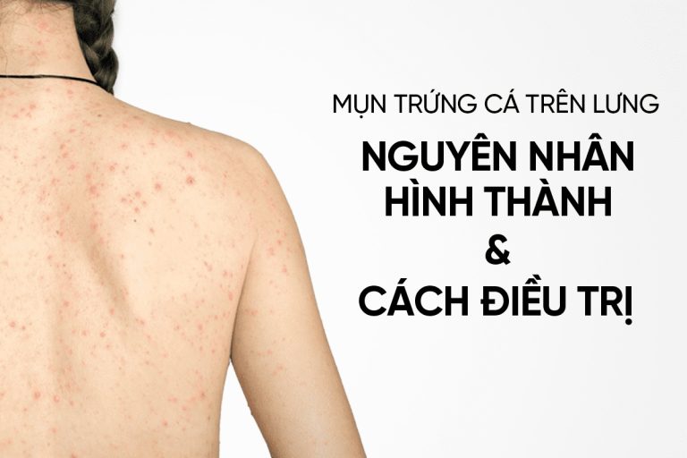 Mụn trứng cá trên lưng
