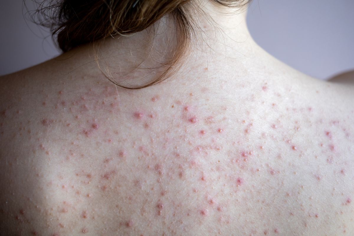 Mụn trứng cá trên lưng