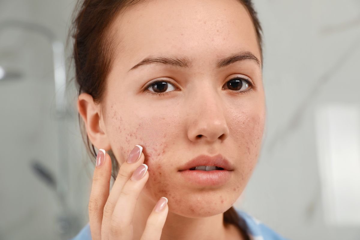 Nguyên nhân bị mụn trứng cá