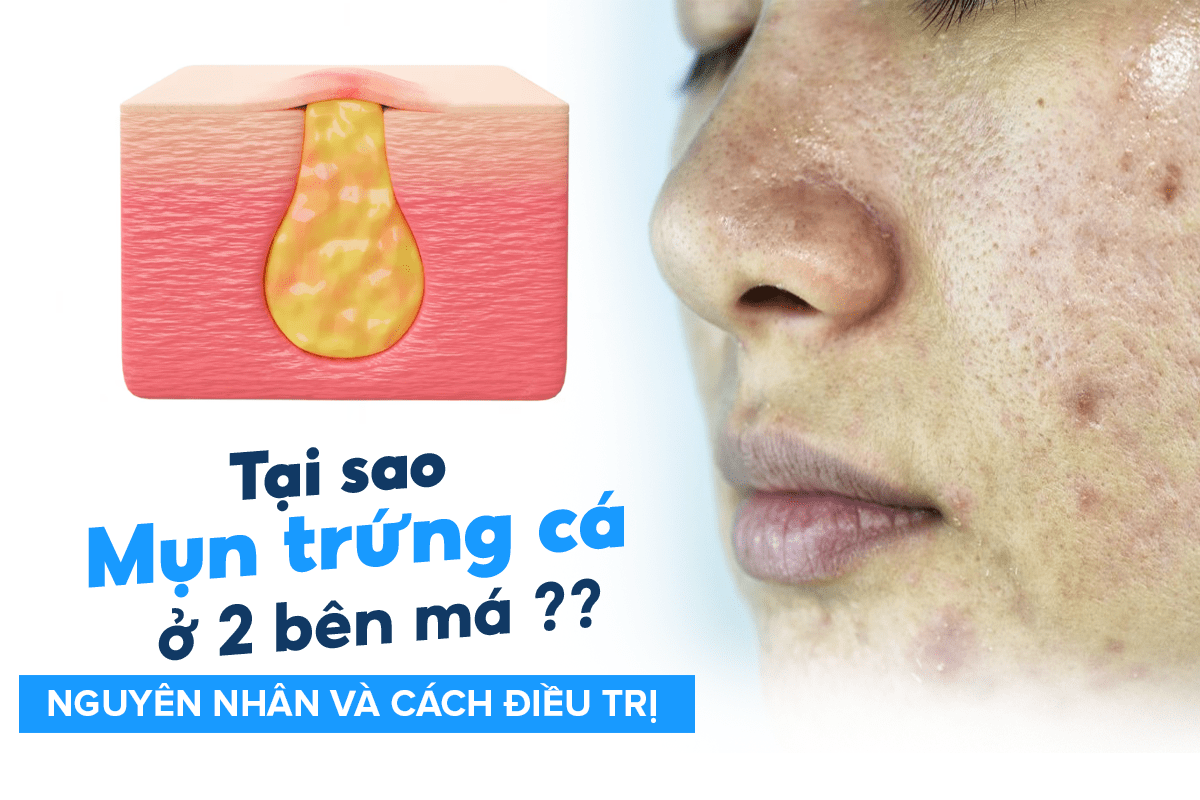 Nguyên nhân và cách điều trị mụn trứng cá ở hai bên má