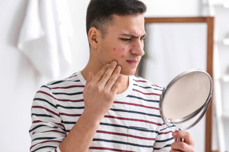 Nguyên nhân gây mụn nội tiết ở nam và cách điều trị