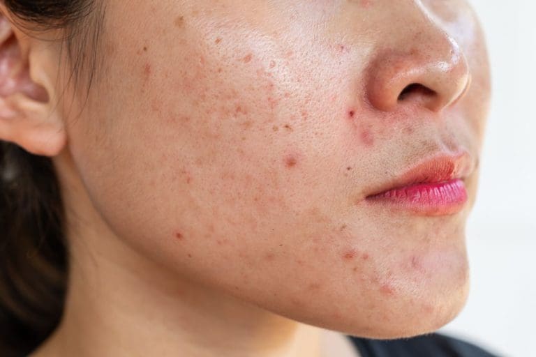 Da dầu là gì? Nguyên nhân và cách chăm sóc da dầu