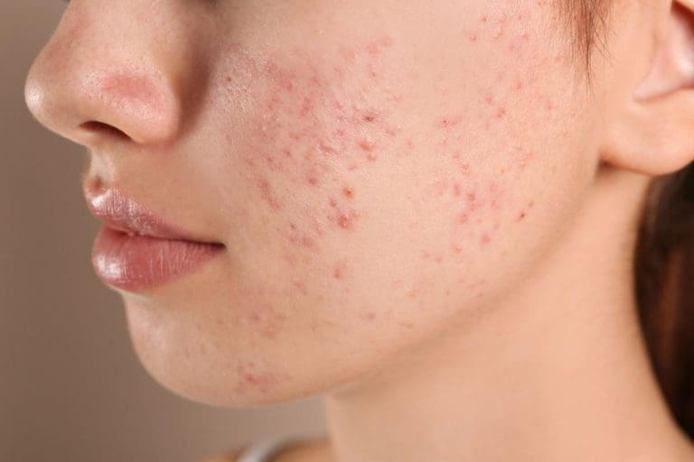 6 bước chăm sóc da dầu mụn giúp giảm mụn hiệu quả