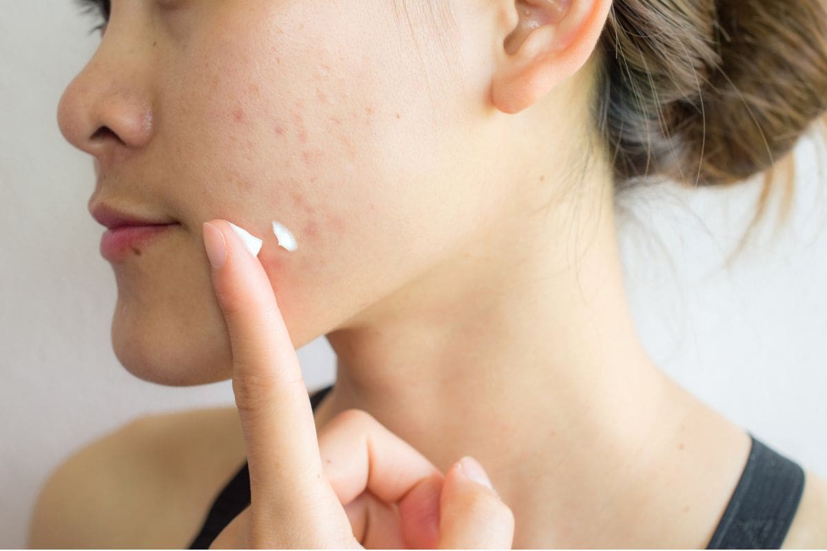 Sử dụng kem trị mụn